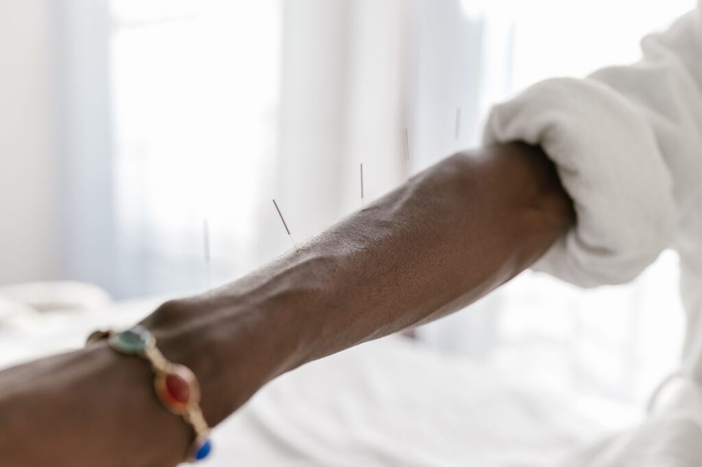 Acupuncture : Principes, Déroulé de Séance et Indications